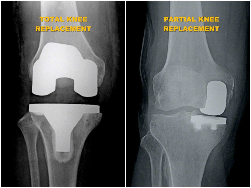 Partial Unicondylar Knee Replacement Orthoist