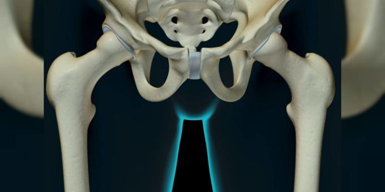 Displasia Del Desarrollo De Cadera - Orthoist