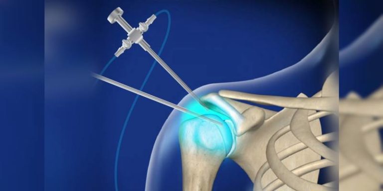 Arthroscopy - Orthoist