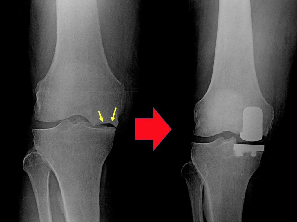 Partial (Unicondylar) Knee Replacement - Orthoist