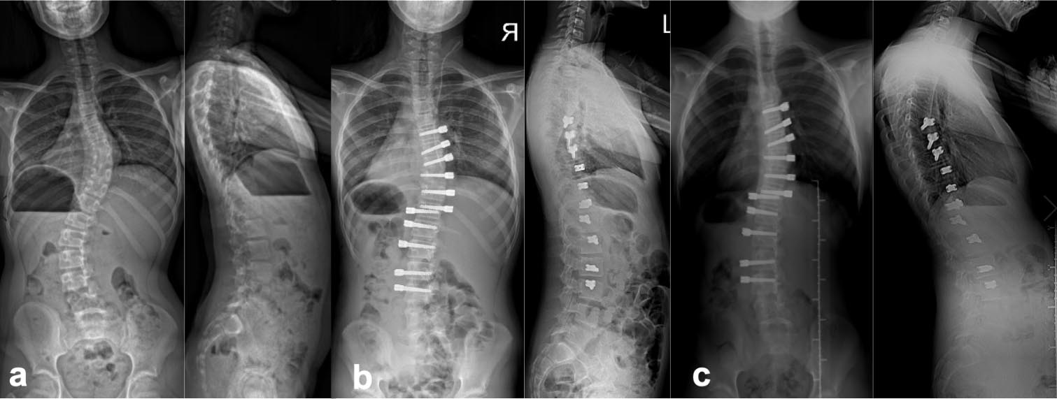 Vertebral Body Tethering