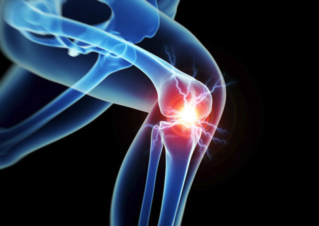 what-to-expect-after-total-knee-replacement-orthoist